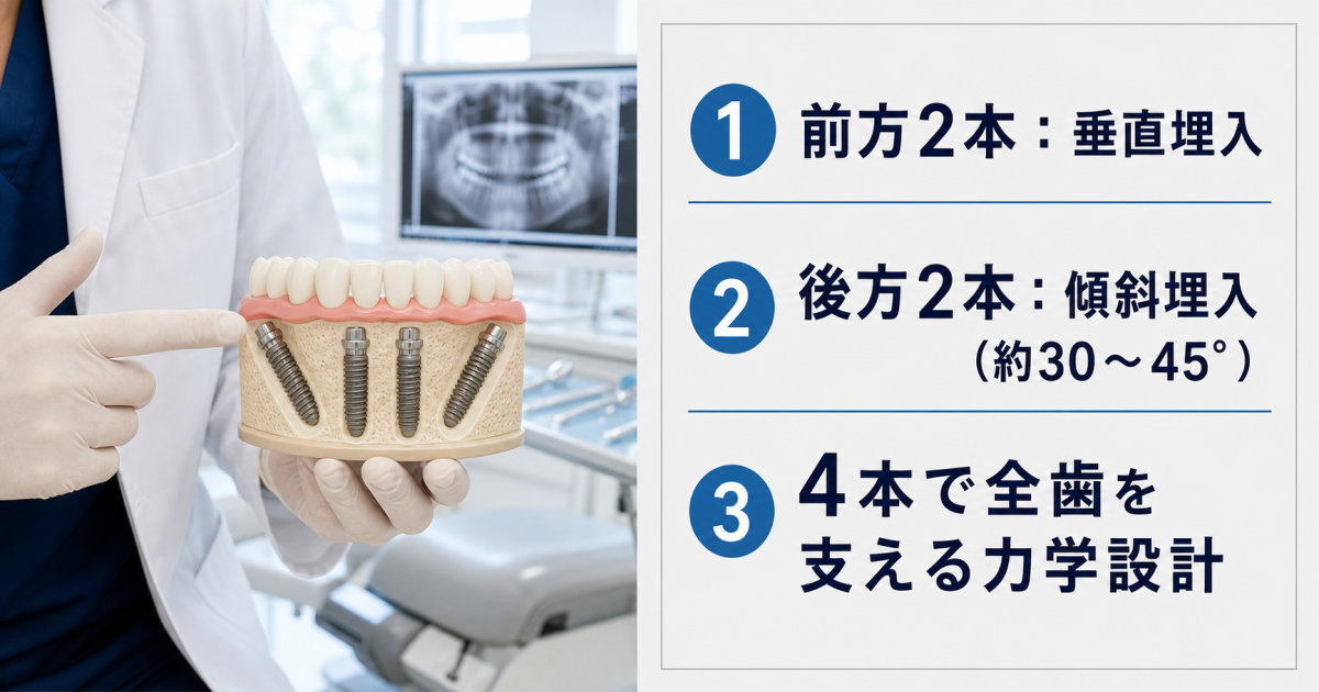 オールオンフォーの仕組み|傾斜埋入が4本で全歯を支えられる力学的根拠