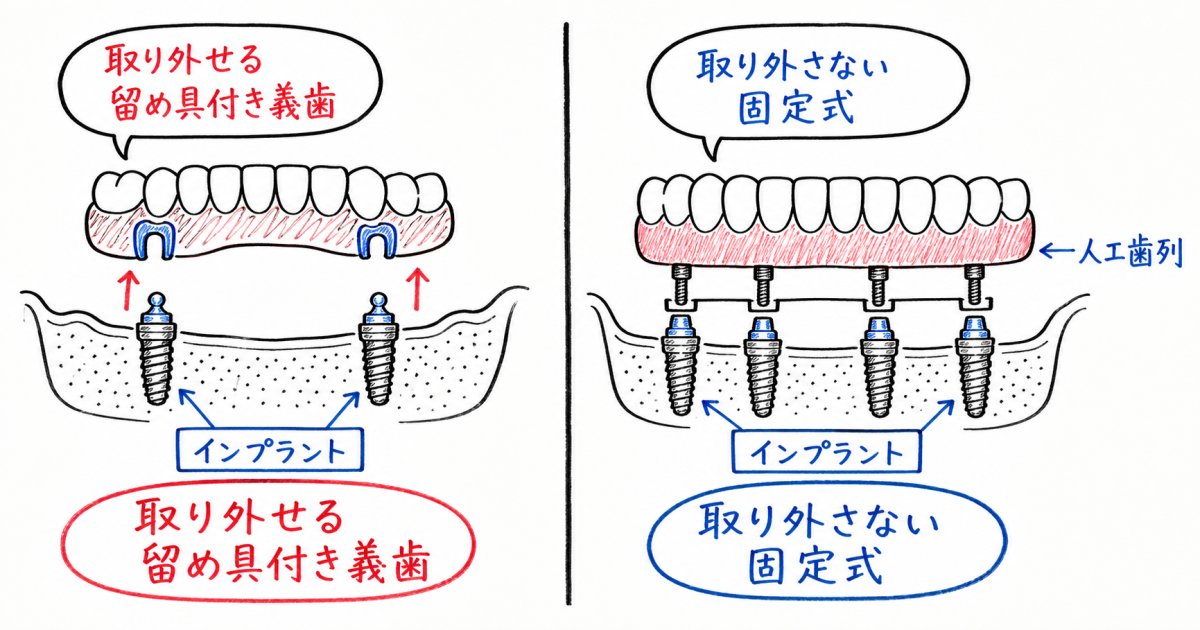 しっかり噛みたい方のための選択肢｜固定式入れ歯の特徴