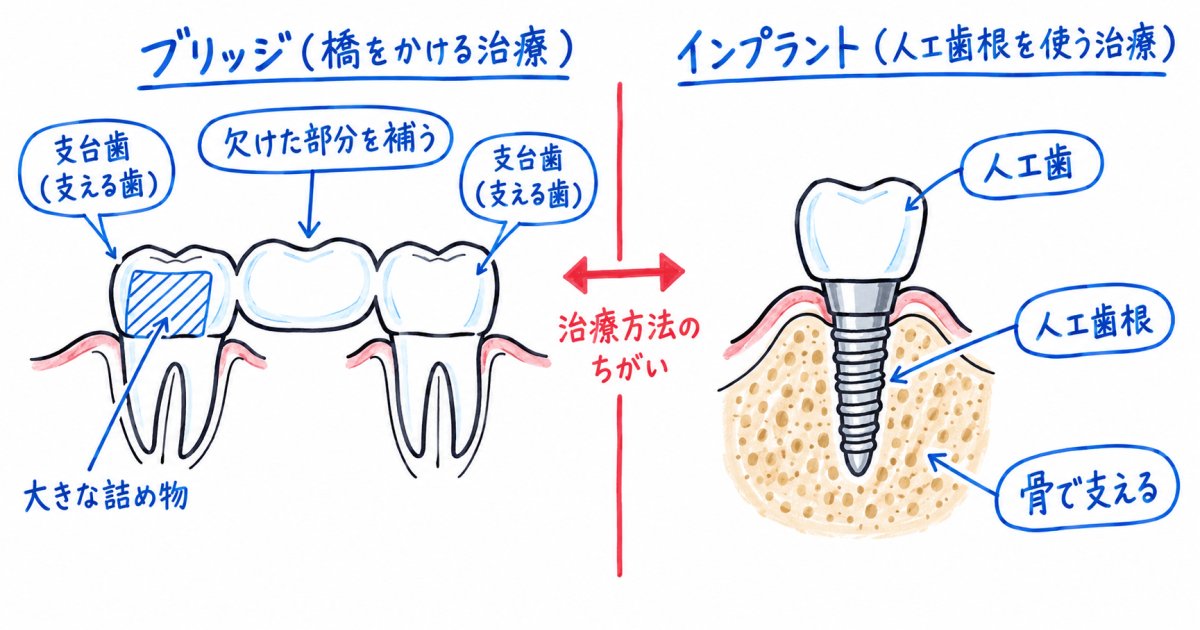 人工歯をどう支える?隣の歯への負担と治療できる条件